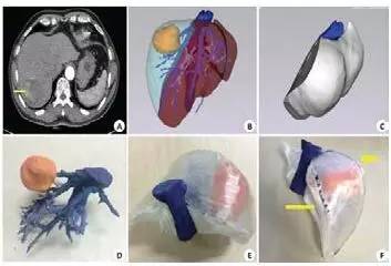 3d打印在醫療領域的應用 3D打印與醫療行業白皮書