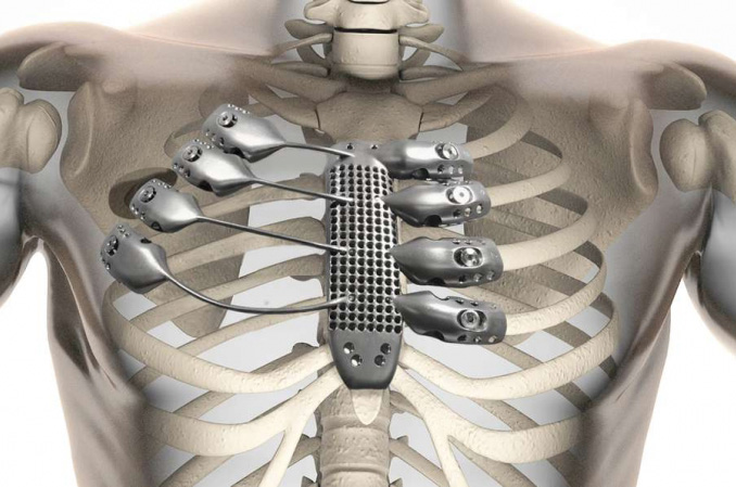 3D打印醫(yī)療器械將在我國迎來蓬勃發(fā)展