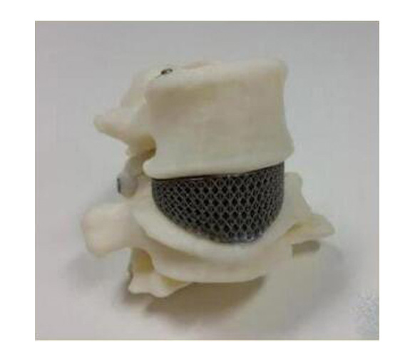 腰椎金屬植入物1